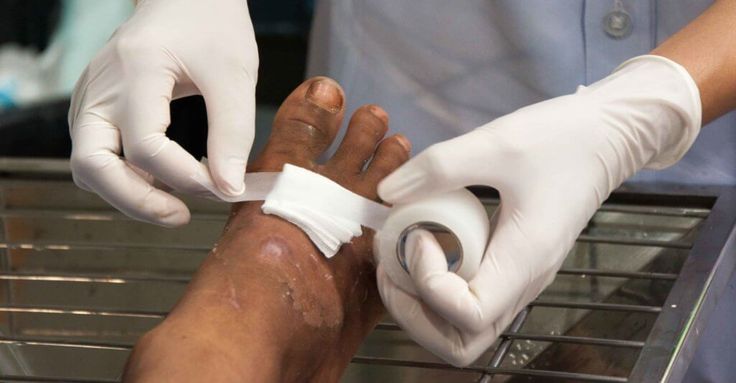 why is wound dressing change frequency important